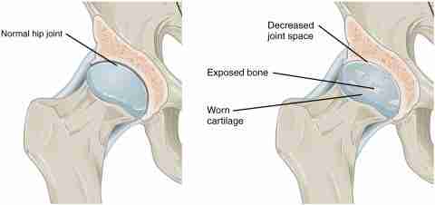 Greater Trochanteric Bursitis Houston Shockwave Therapy